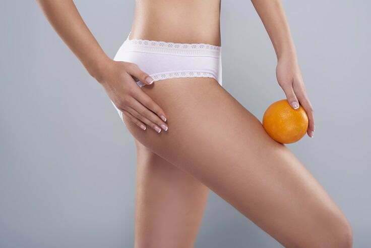 Addressing the ‘What’ & ‘Why’ of Cellulite