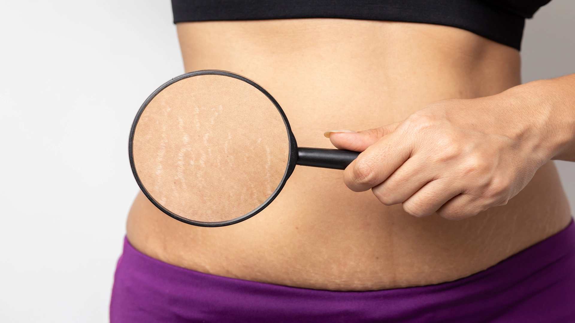Stretch Marks During Pregnancy? This Cutting-Edge Tech May Help You