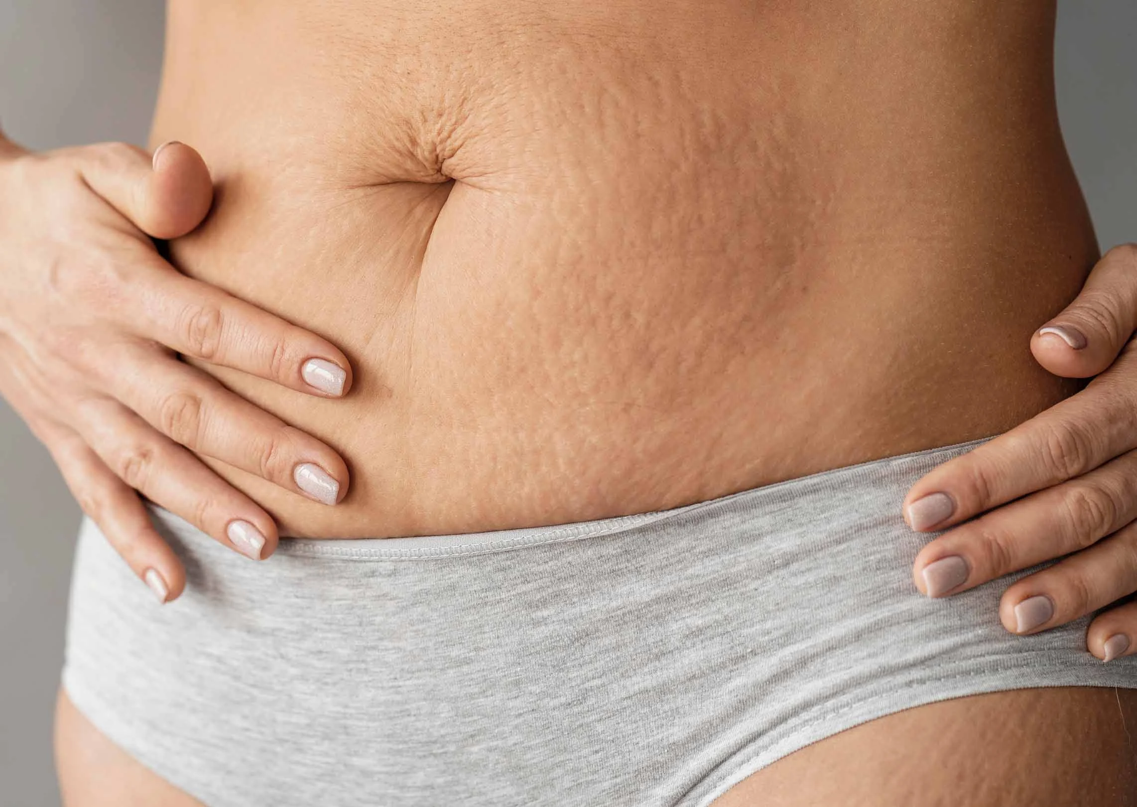 Eliminate Stretch Marks Stomach without Surgery