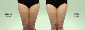 Emtone cellulite treatment at AKARA - before and after for Thighs